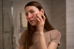 Je za rdečico kriv histamin?